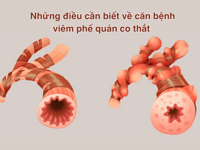 Những điều cần biết về căn bệnh viêm phế quản co thắt